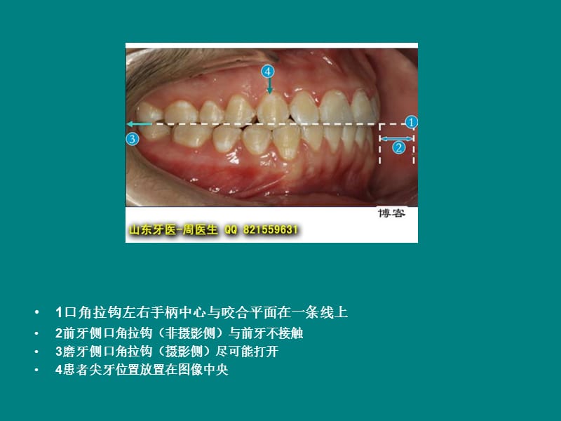 跟我学口腔摄影-拍摄美国正畸协会(ABO)口内像.ppt_第3页