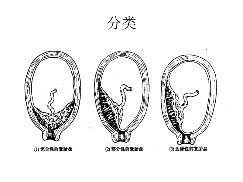 《前置胎盘护理》PPT课件.ppt_第3页