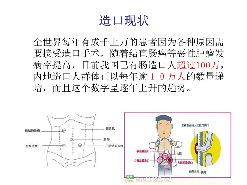 造口护理健康宣教.ppt_第2页