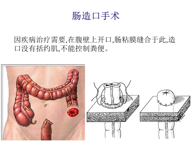 造口护理健康宣教.ppt_第3页