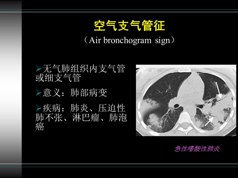 胸部疾病常见影像学征象.ppt_第3页