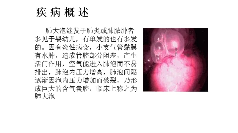 胸腔镜下肺大泡切除术.ppt_第3页