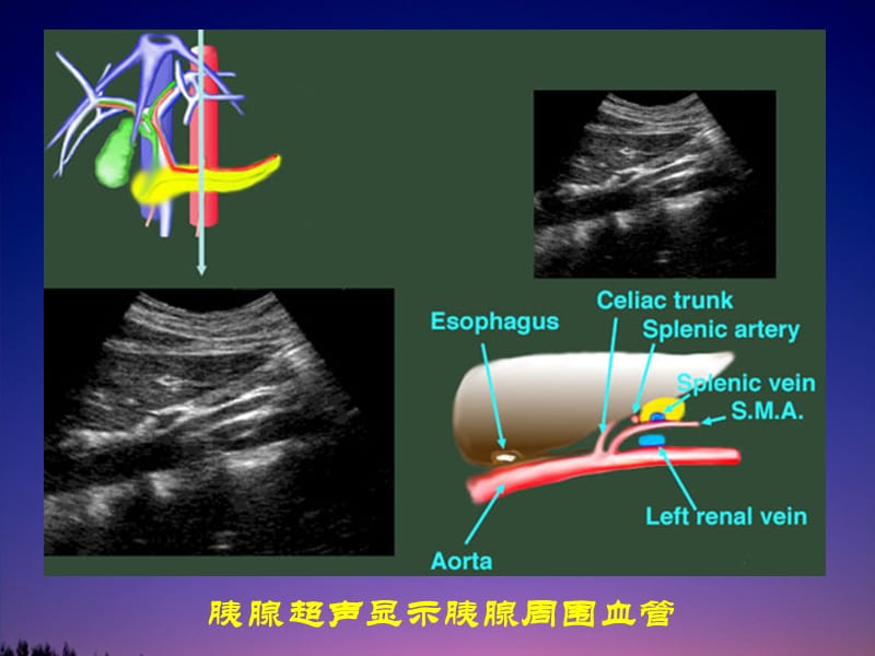 磁共振胰胆管水成像(MRCP).ppt_第3页