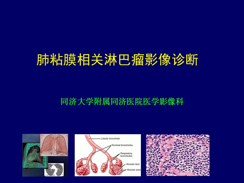 肺粘膜相关淋巴瘤影像特征.ppt_第1页