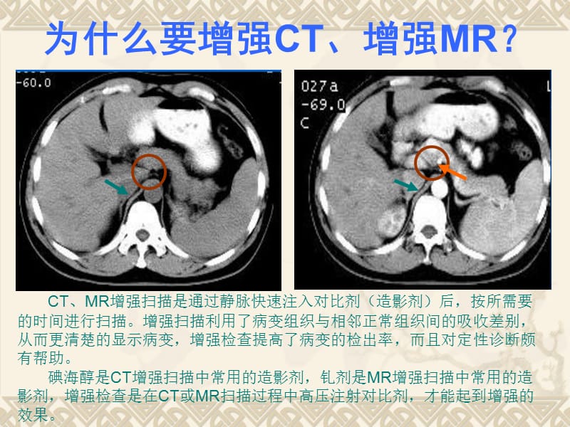 造影剂(对比剂)外渗预防与处理.ppt_第3页