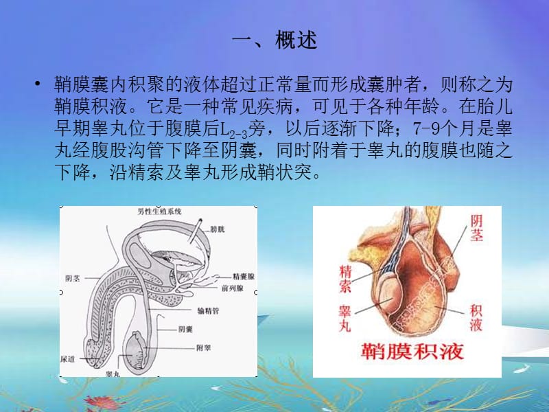 鞘膜积液业务学习ppt课件.ppt_第2页