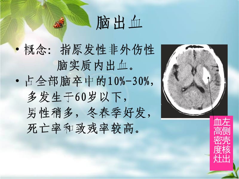 脑出血恢复期患者的护理.ppt_第3页