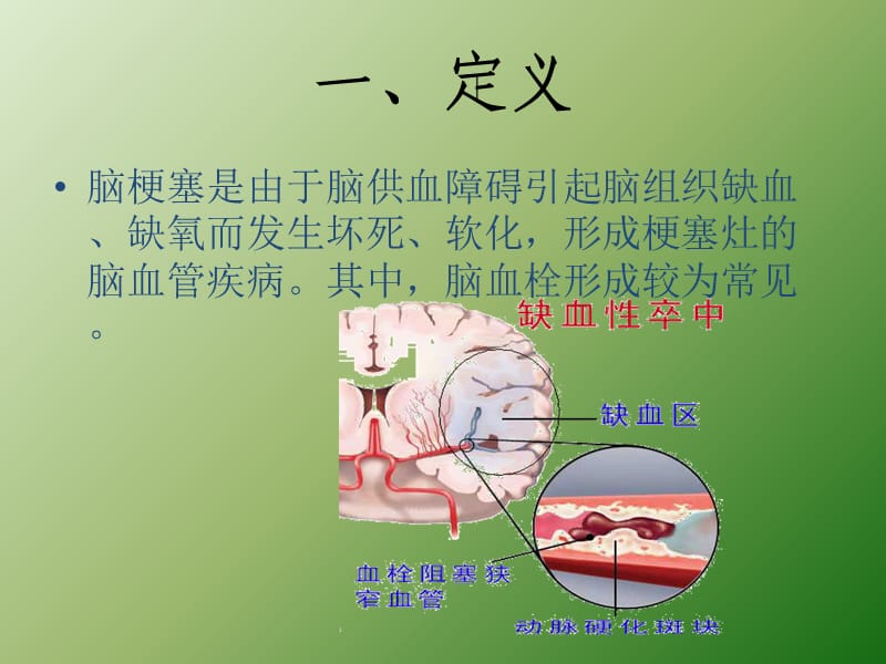 脑梗塞的护理常规ppt课件_第2页