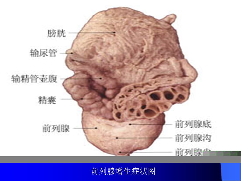 经尿道前列腺电切术的健康教育ppt课件_第3页