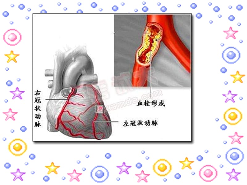 心肌梗死护理查房ppt课件_第3页