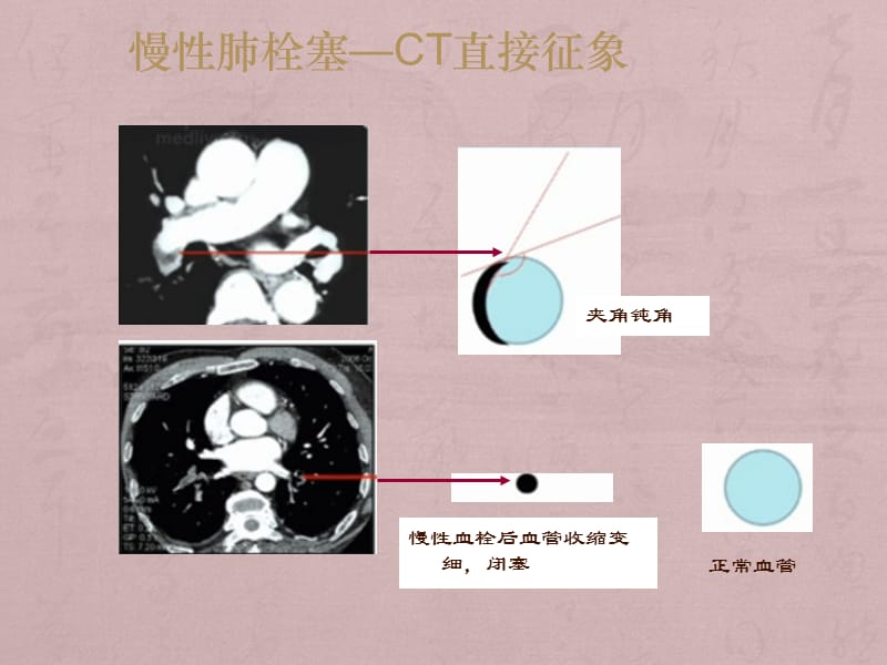 临床医生如何读片CTPA诊断肺栓塞下ppt课件_第3页