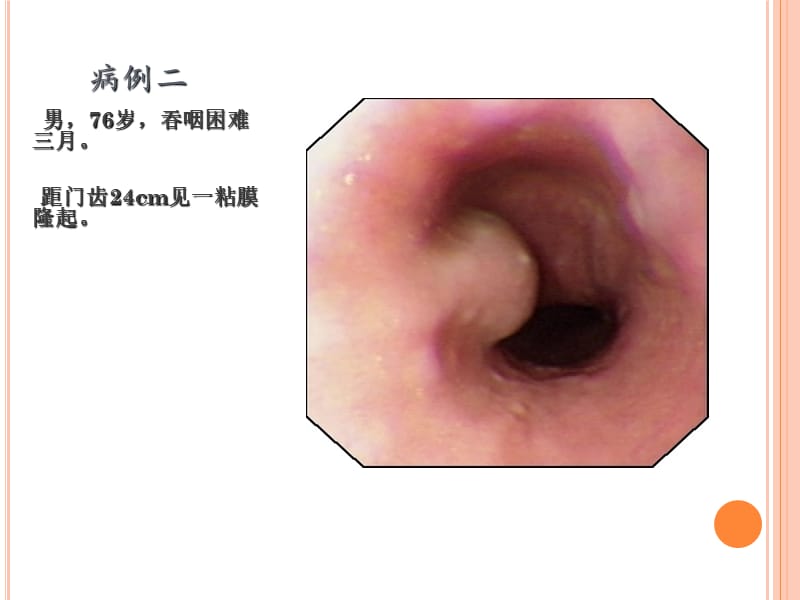 【PPT课件】消化道黏膜隆起性病变的超声内镜诊断_第3页