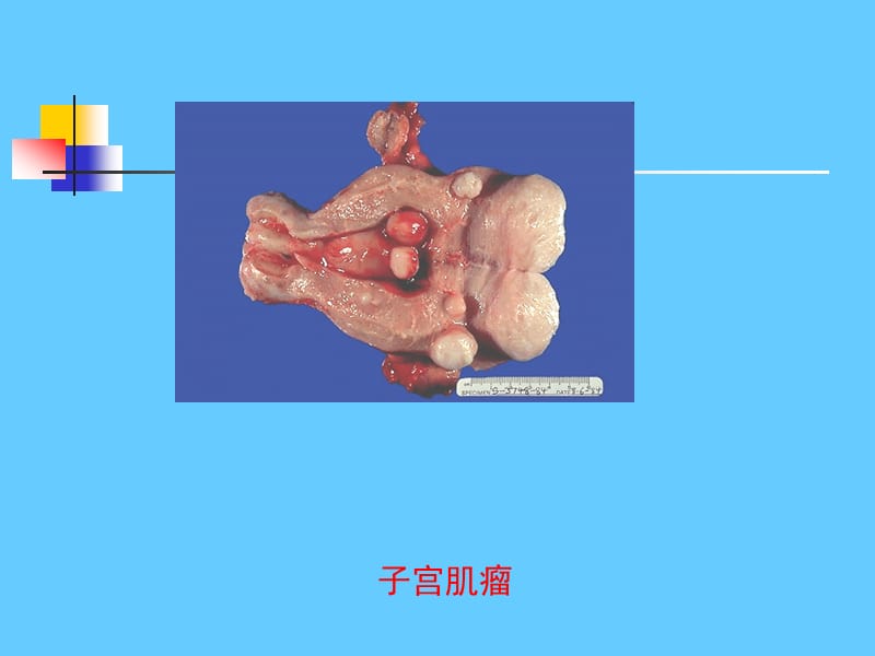 子宫肌瘤 课件ppt课件_第3页