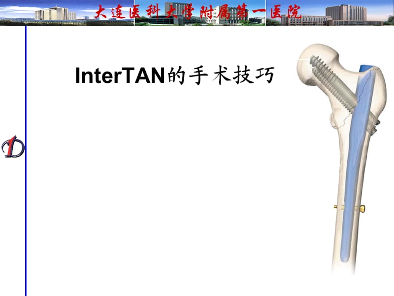 Intertan的手术技巧.ppt_第1页