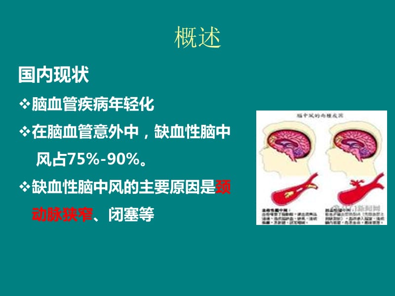 颈动脉内膜剥脱术护理ppt课件_第3页