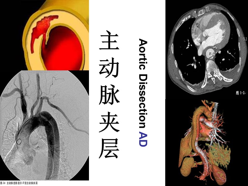 《主动脉夹层》PPT课件.ppt_第1页