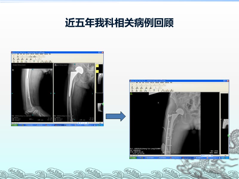 髋关节术后假体周围骨折ppt课件_第2页