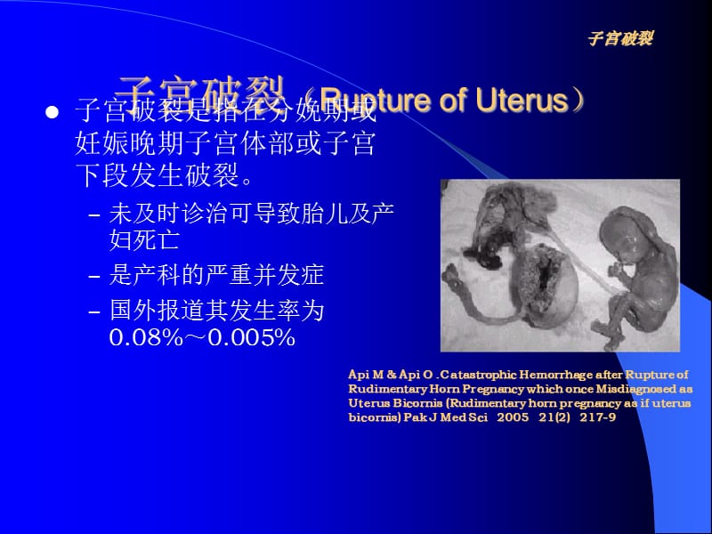 子宫破裂 Microsof oweroin 演示文稿 ppt课件_第3页