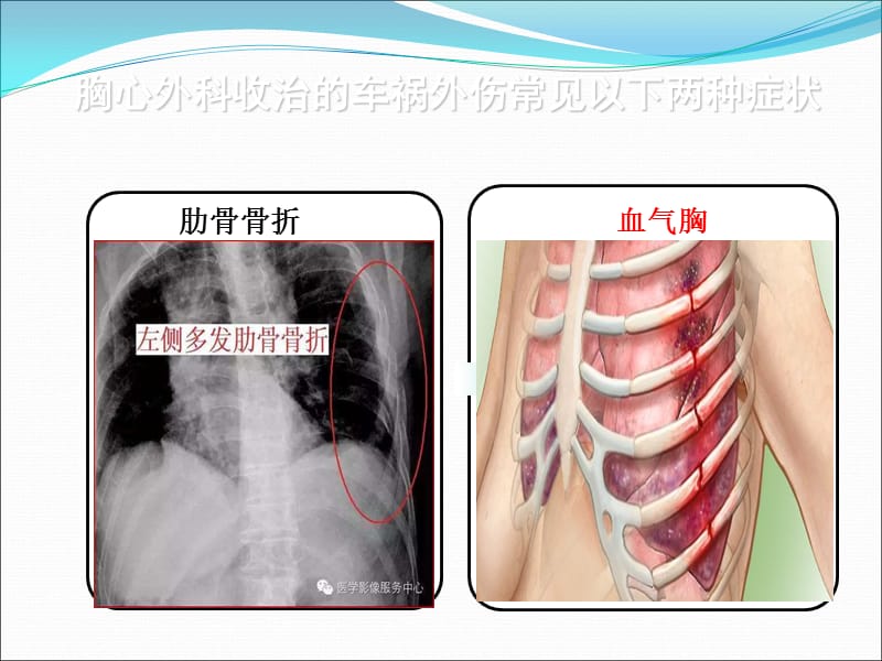 胸腔闭式引流术ppt课件_第3页