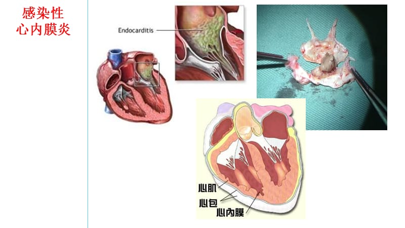感染性心内膜炎要点及习题讲解ppt课件_第3页