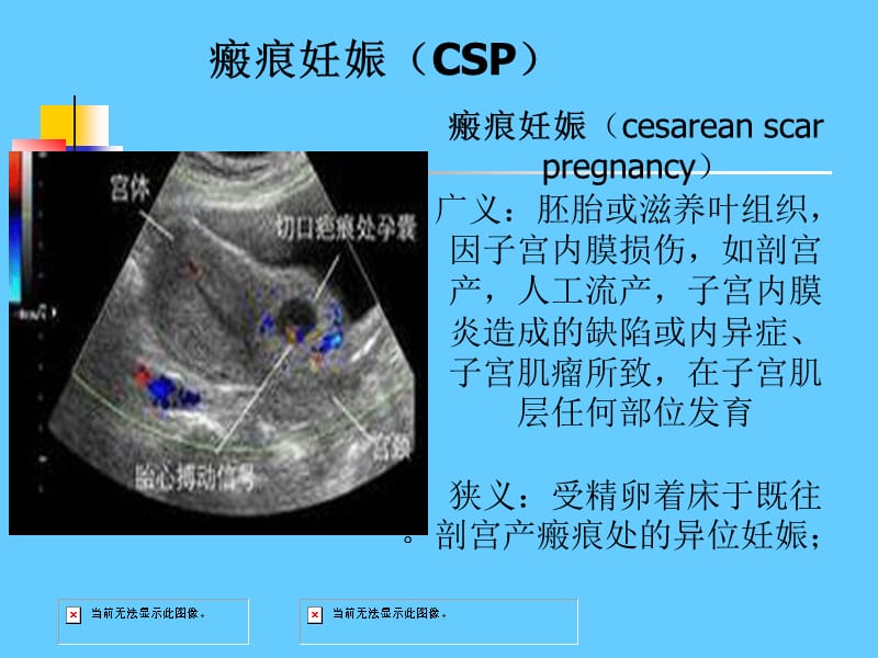 子宫瘢痕妊娠ppt课件_第2页