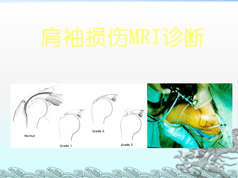 肩袖损伤MRI诊断ppt课件_第1页