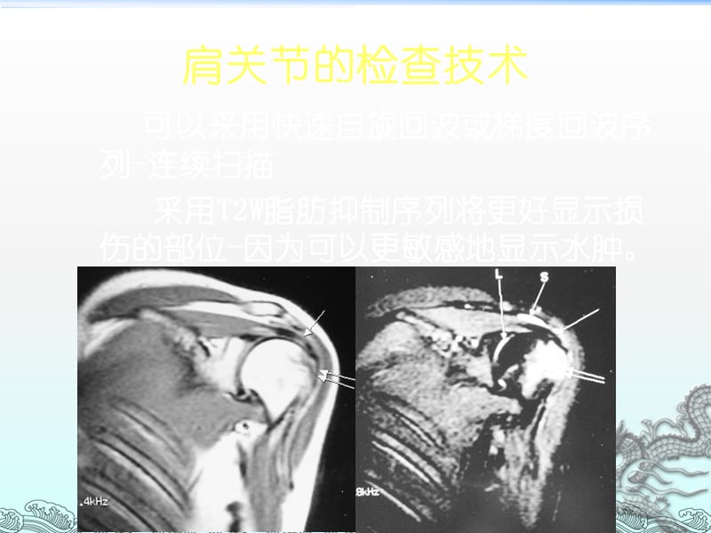 肩袖损伤MRI诊断ppt课件_第3页