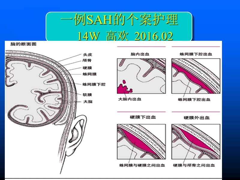 蛛网膜下腔出血的个案护理最终ppt课件_第1页