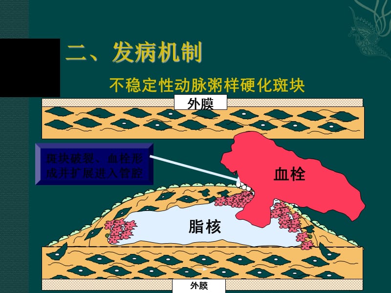 急性心肌梗死 新ppt课件_第3页