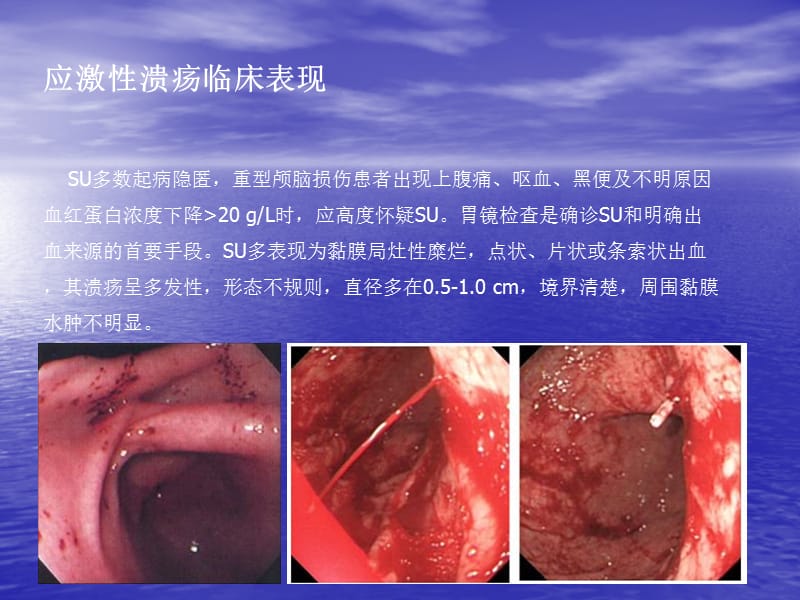 应激性溃疡副本ppt课件_第3页