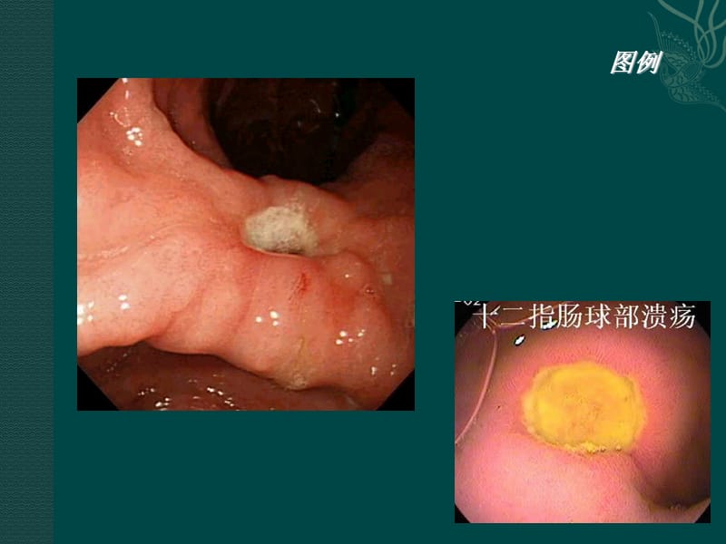 十二指肠球部溃疡ppt课件_第3页