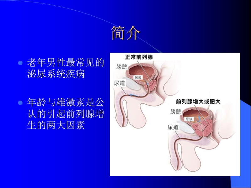 前列腺增生教学查房ppt课件_第2页