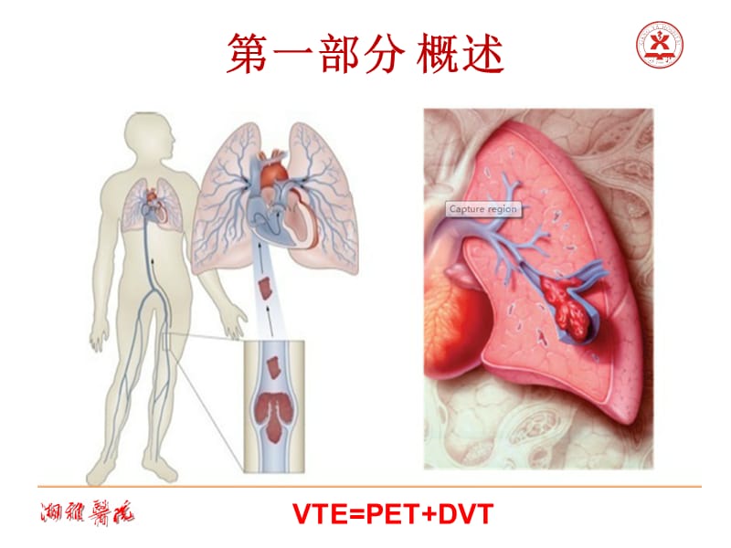 2018肺栓塞指南解读.ppt_第3页