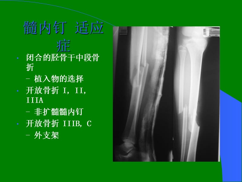 胫骨干骨折ppt课件_第3页