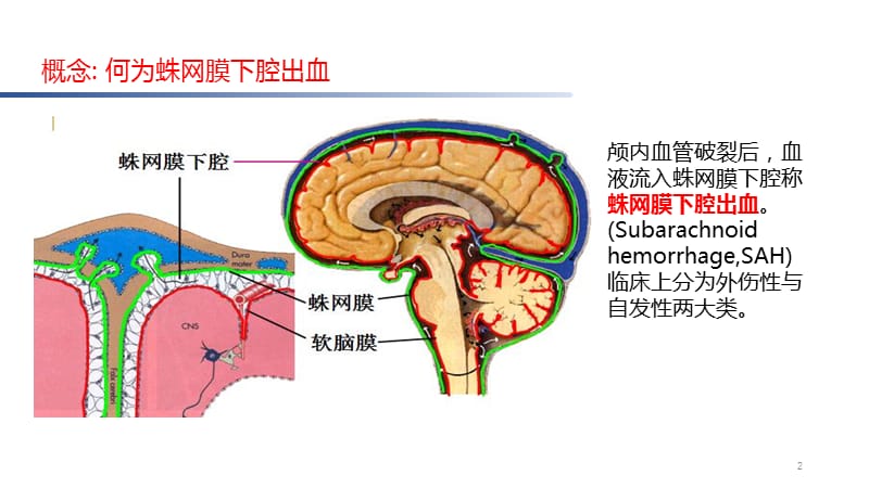 2019脑卒中规范化培训课件.蛛网膜下腔出血诊治规范.ppt_第2页