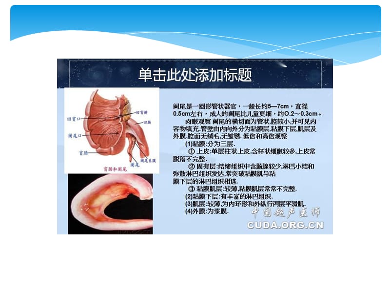 阑尾炎的超声诊断ppt课件_第3页