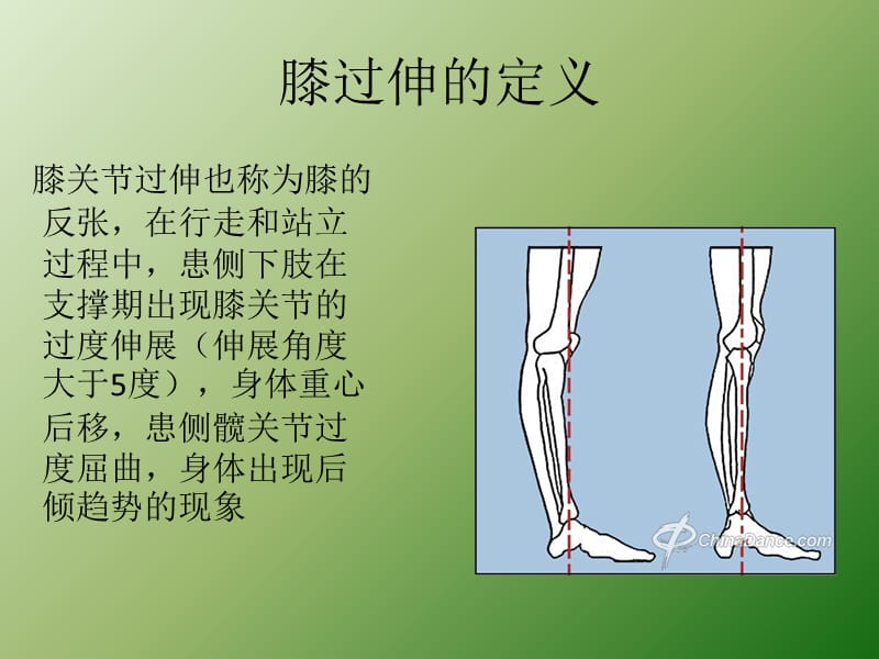 膝过伸的原因和训练方法ppt课件_第1页