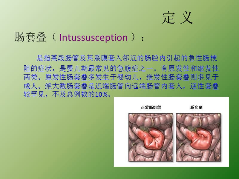 小儿肠套叠课件ppt课件_第3页