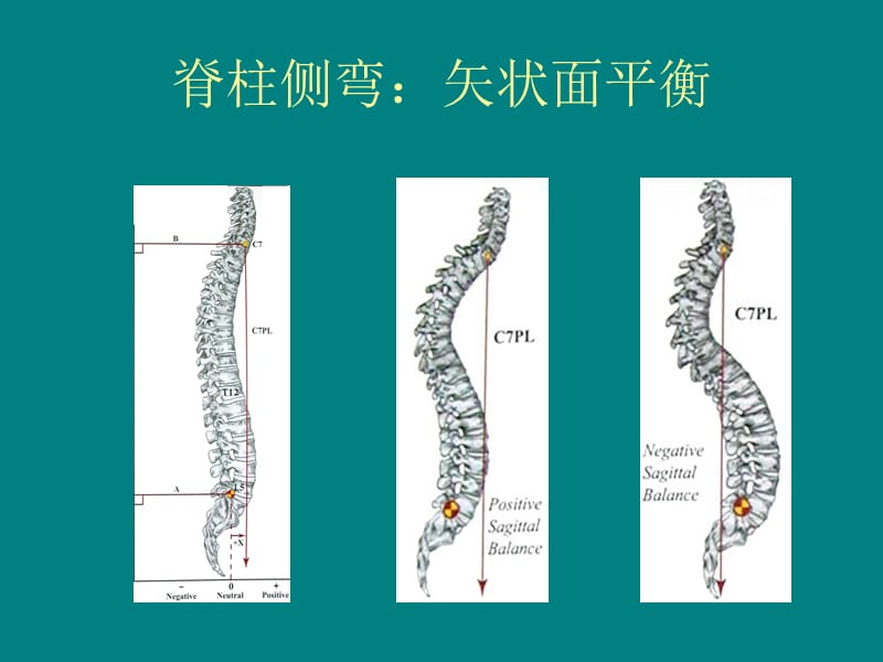 脊柱侧弯_第3页