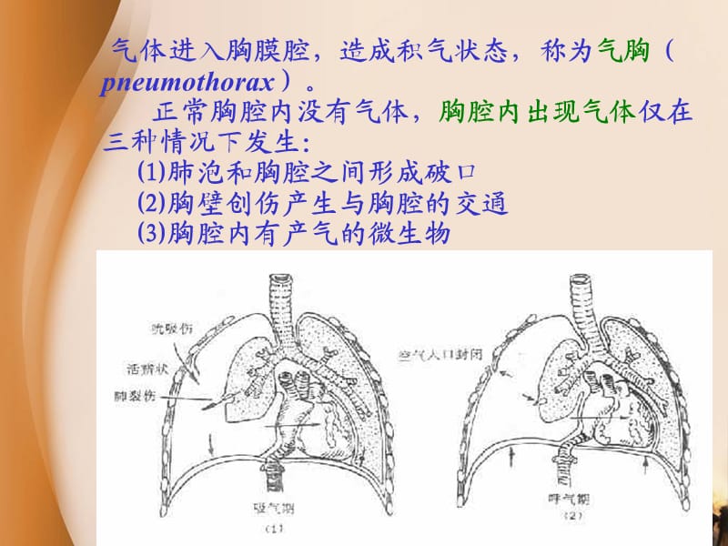 内科胸腔闭式引流术.ppt_第3页