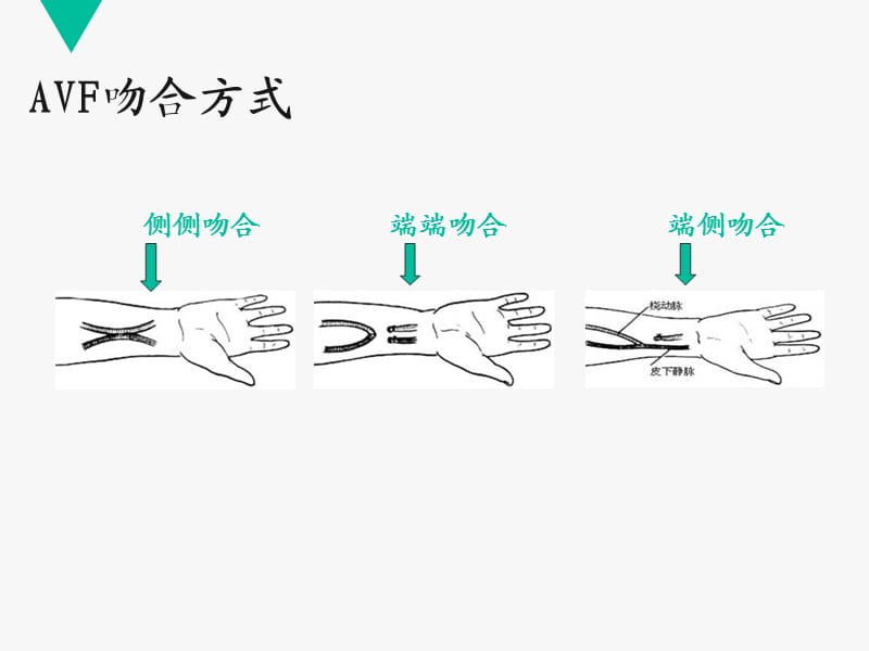 动静脉内瘘栓塞的原因分析及干预措施_第3页