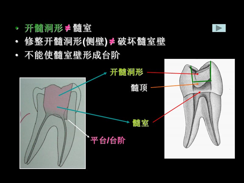 上颌磨牙开髓ppt课件_第2页