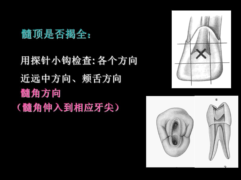 上颌磨牙开髓ppt课件_第3页