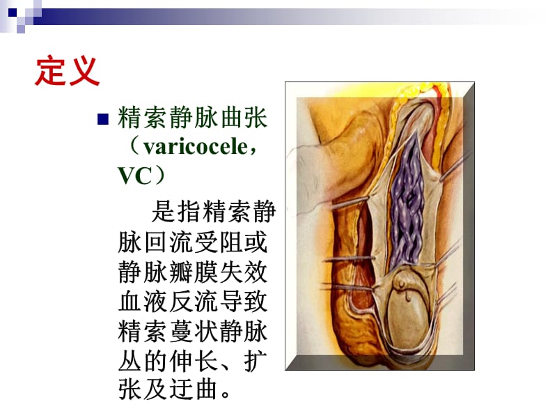 精索静脉曲张诊断治疗及护理_第2页