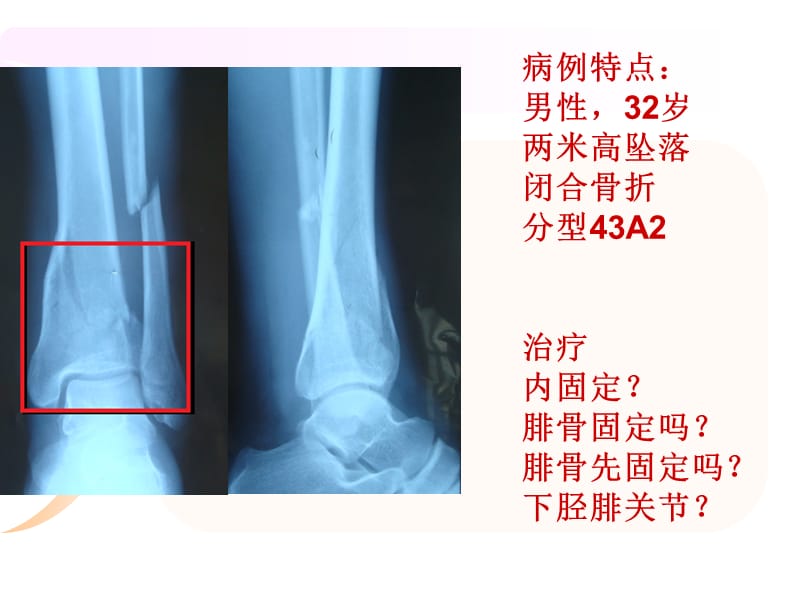 《腓骨骨折内固定》PPT课件.ppt_第2页