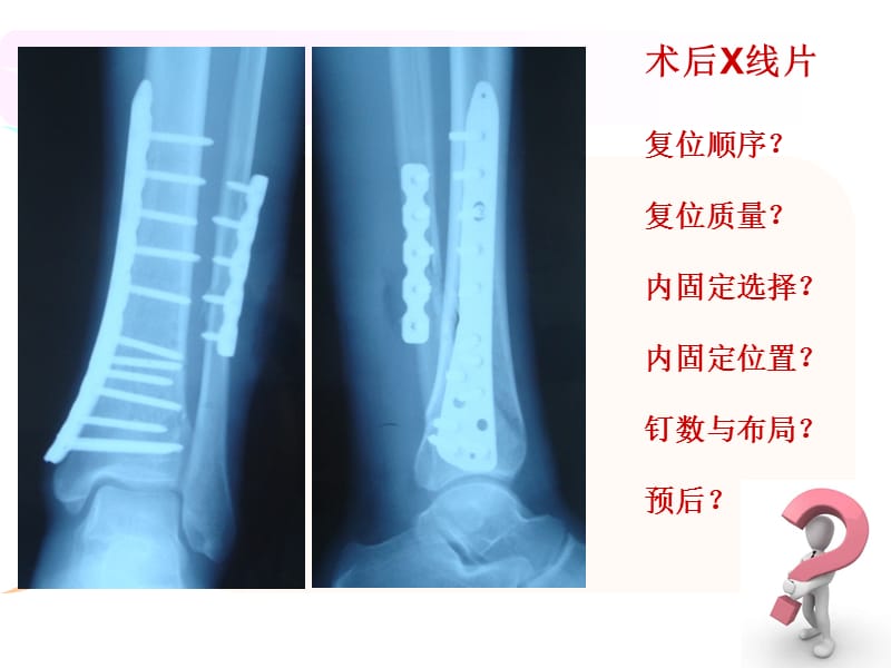 《腓骨骨折内固定》PPT课件.ppt_第3页