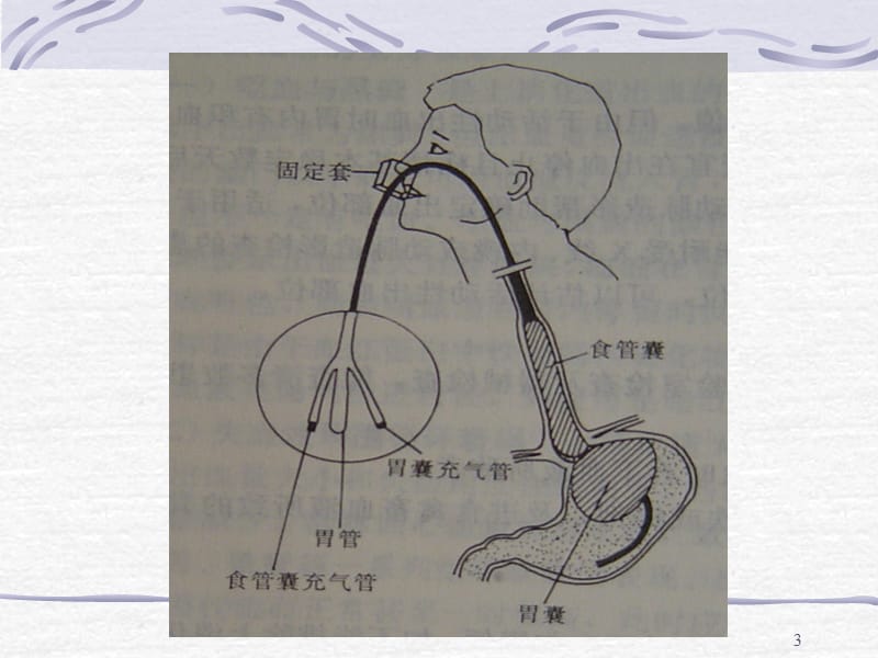 三腔二囊管的应用和护理ppt课件_第3页