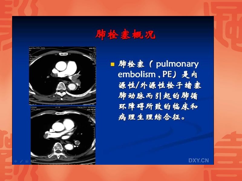 《肺动脉栓塞CTA》PPT课件.ppt_第2页