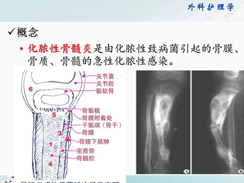 化脓性骨髓炎患者的护理.ppt_第3页