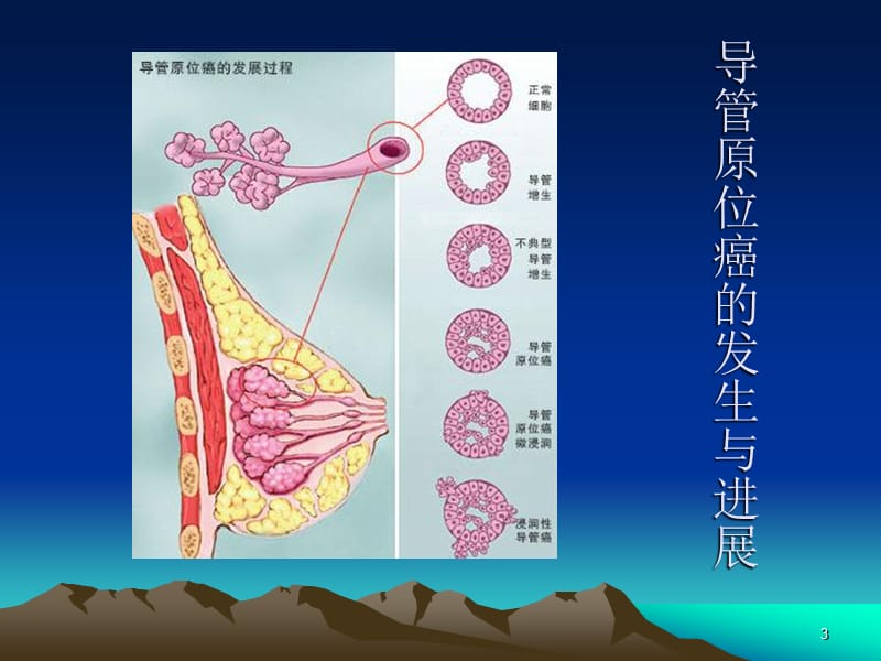 乳腺导管原位癌ppt课件_第3页